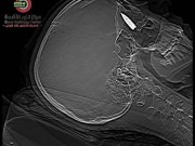 بالصور  معجزة طبية في القاهرة.. إزالة طلق ناري من جمجمة شابة فلسطينية